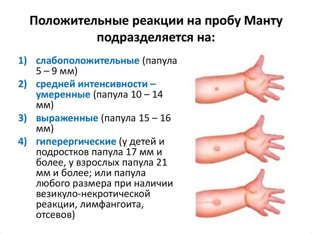 Интерпретация результатов реакции Манту