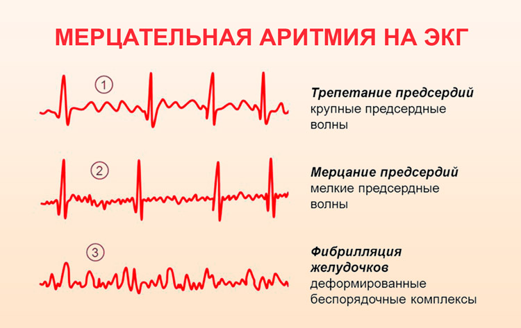 Осложнение на сердце после КОВИДа