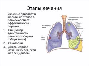 Этапы лечения туберкулеза
