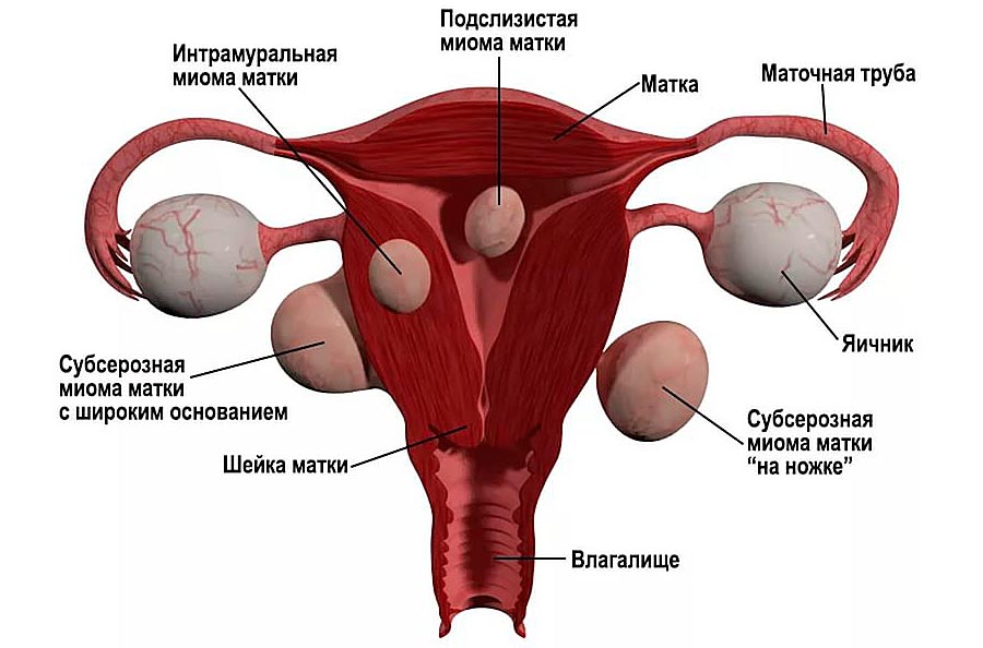 Миома матки: этиология, патогенез, симптомы и методы лечения