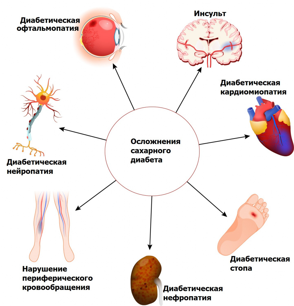 Осложнения сахарного диабета