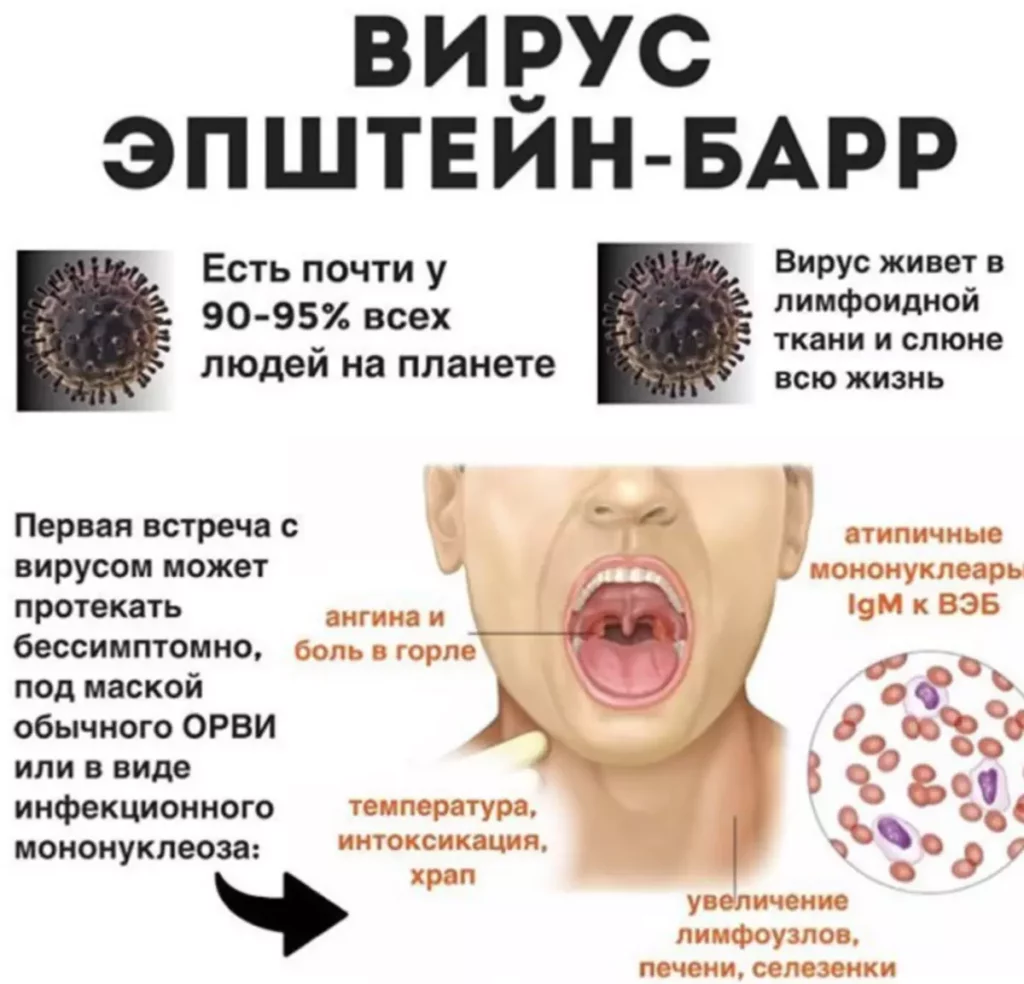 Инфекционный мононуклеоз