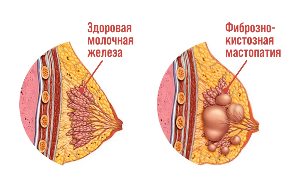 Грудная железа в норме и при ироно-кистозной мастопатии