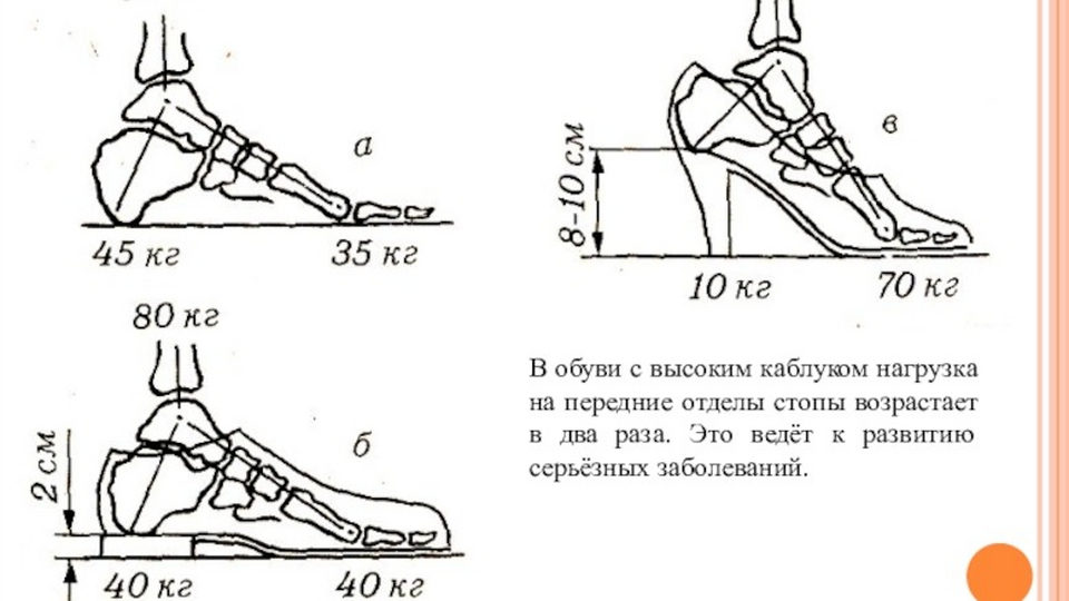 Поддержка дуги стопы